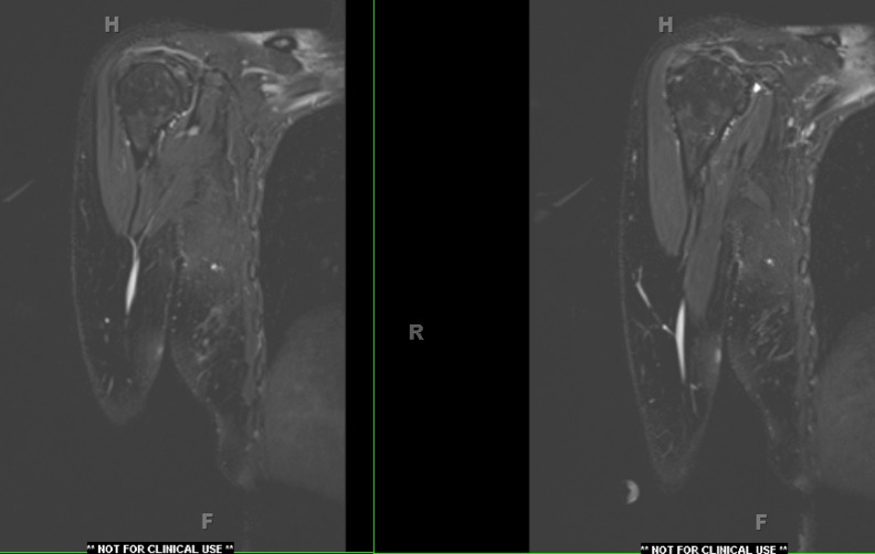 Figure 2 for case Multifocal motor neuropathy